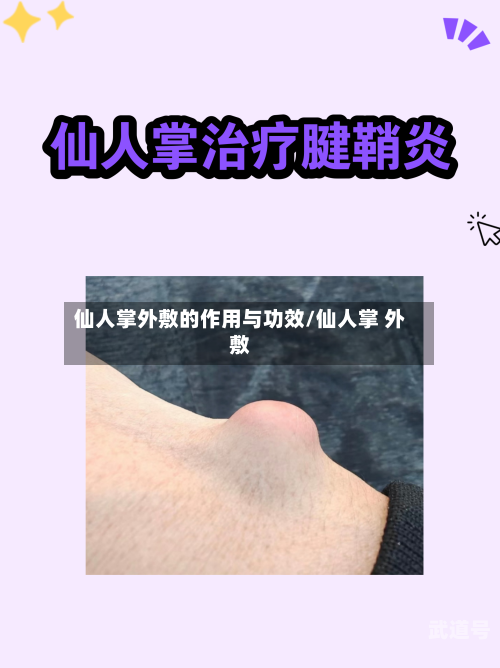 仙人掌外敷的作用与功效/仙人掌 外敷